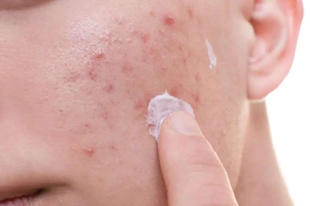 acne